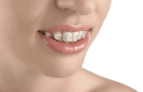 Ceramic Braces from your Greater Salt Lake Area Braces Provider