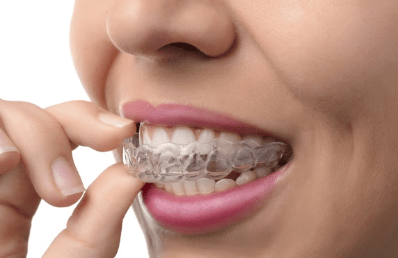 ClearCorrect Aligners