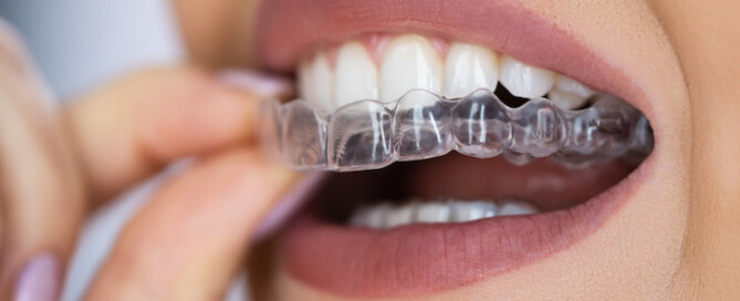 female patient putting on orthodontic aligners