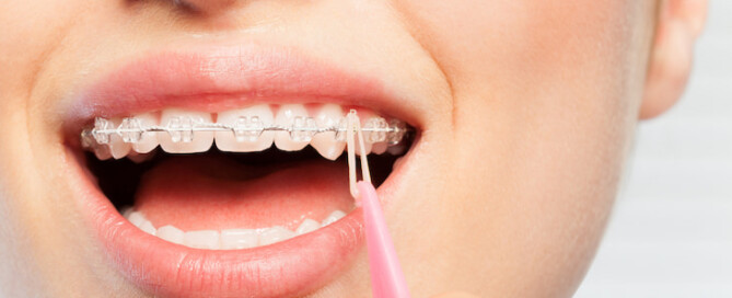 patient installing new orthodontic elastic or ligature on her braces