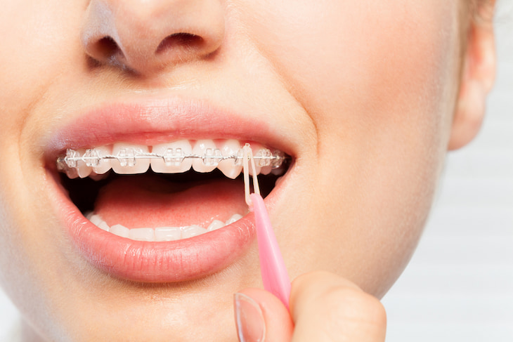 patient installing new orthodontic elastic or ligature on her braces